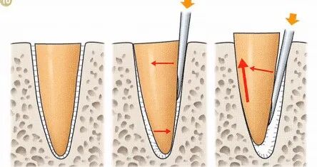 注意牙挺拔牙的技巧，千万别踩雷！