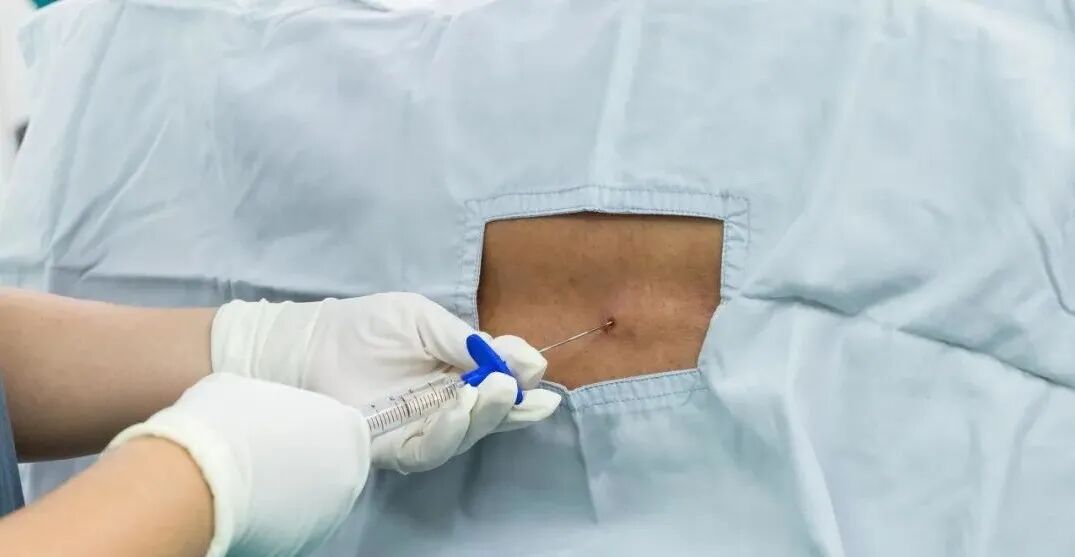 怎么知道穿刺到硬膜外咔！硬膜外麻醉打穿了怎么办？_https://www.jmylbn.com_新闻资讯_第2张