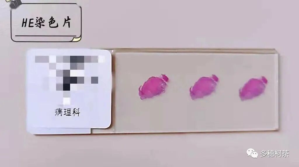 什么是病理蜡块癌症治疗中的白片、切片、染色片、蜡块是什么？看完这个，癌症治疗路上不折腾！_https://www.jmylbn.com_新闻资讯_第7张