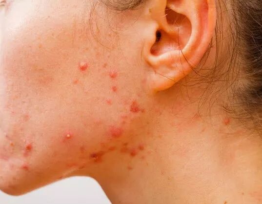 皮肤症状暴露血糖过高！若你有，小心是早期糖尿病，及时控制血糖- 七分 