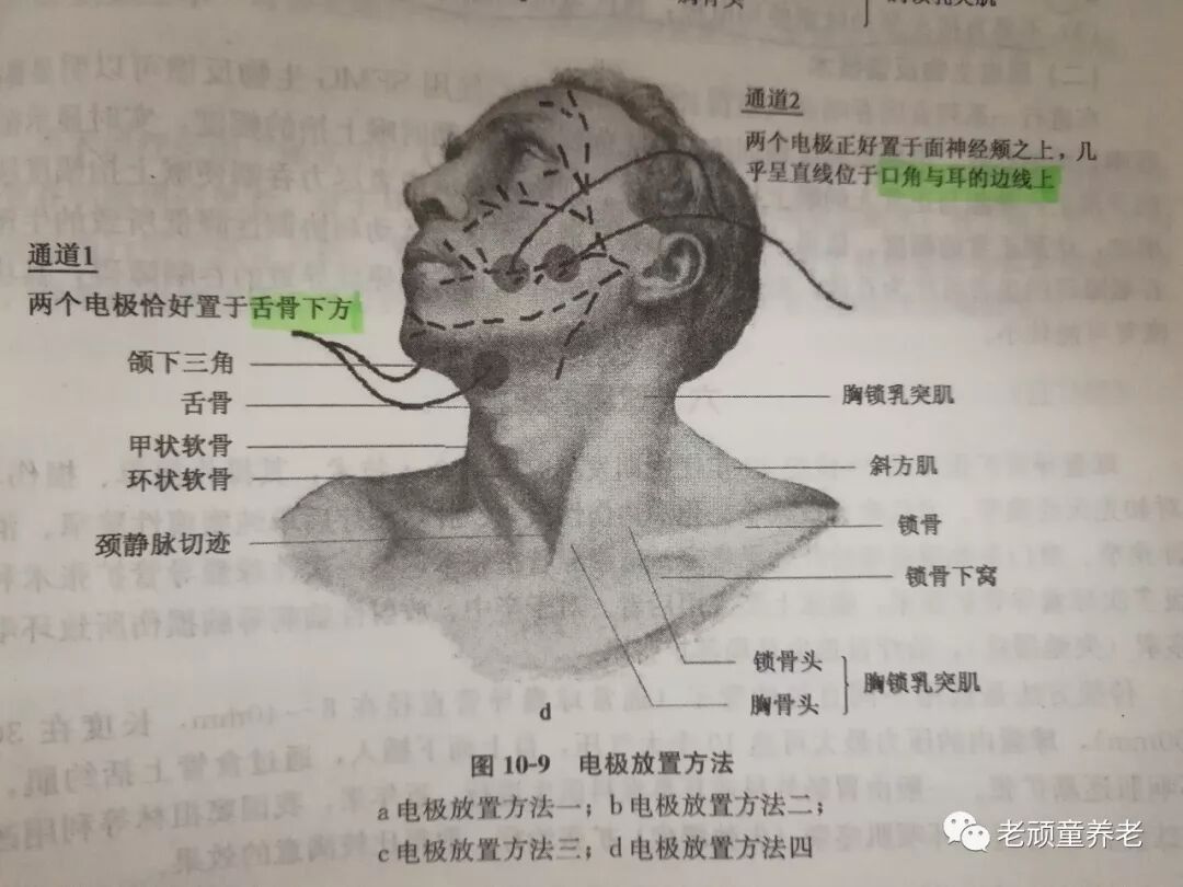 吞咽治疗仪怎么用吞咽障碍丨吞咽障碍电刺激治疗仪 Vital Stim 相关治疗细节_https://www.jmylbn.com_新闻资讯_第11张