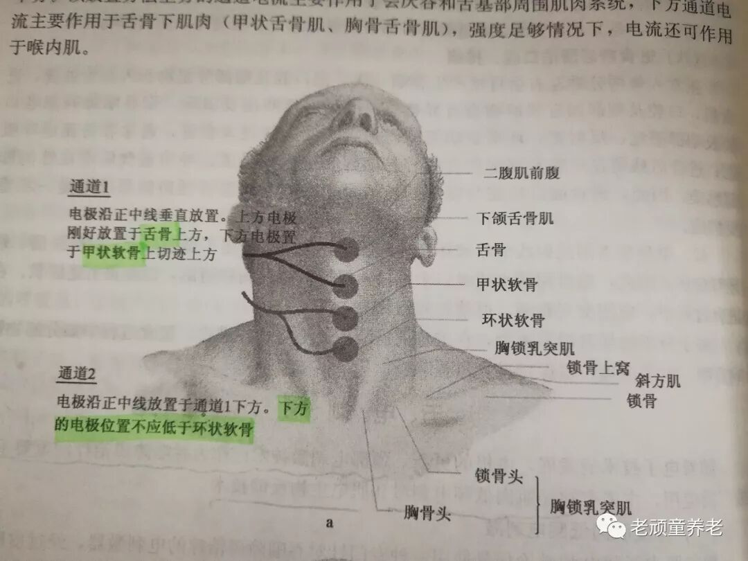 吞咽治疗仪怎么用吞咽障碍丨吞咽障碍电刺激治疗仪 Vital Stim 相关治疗细节_https://www.jmylbn.com_新闻资讯_第8张