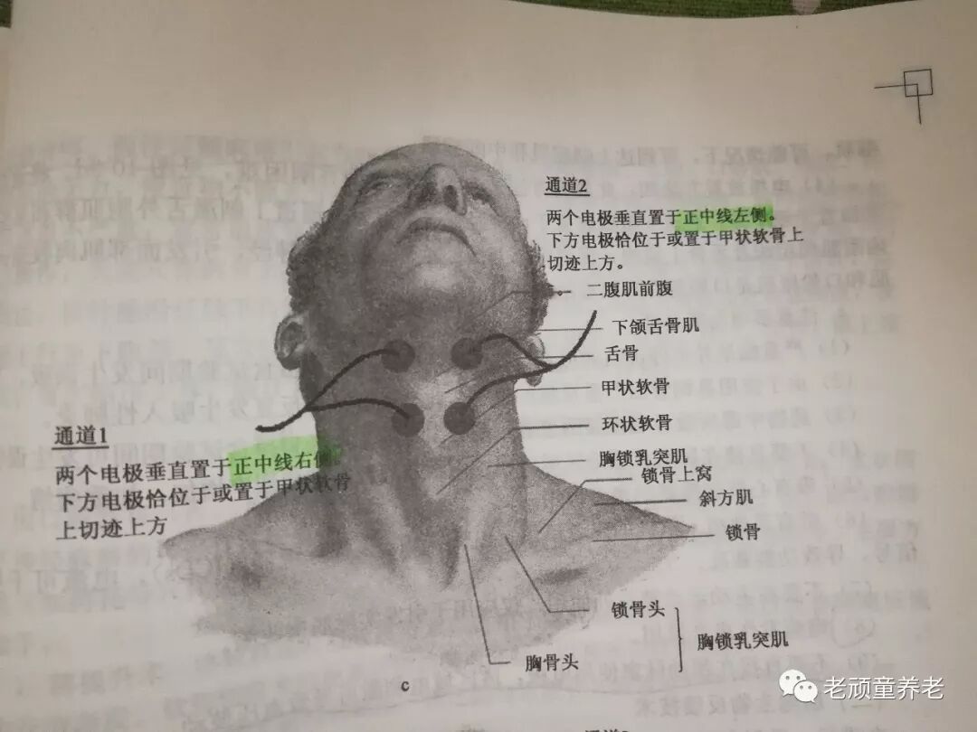 吞咽治疗仪怎么用吞咽障碍丨吞咽障碍电刺激治疗仪 Vital Stim 相关治疗细节_https://www.jmylbn.com_新闻资讯_第10张