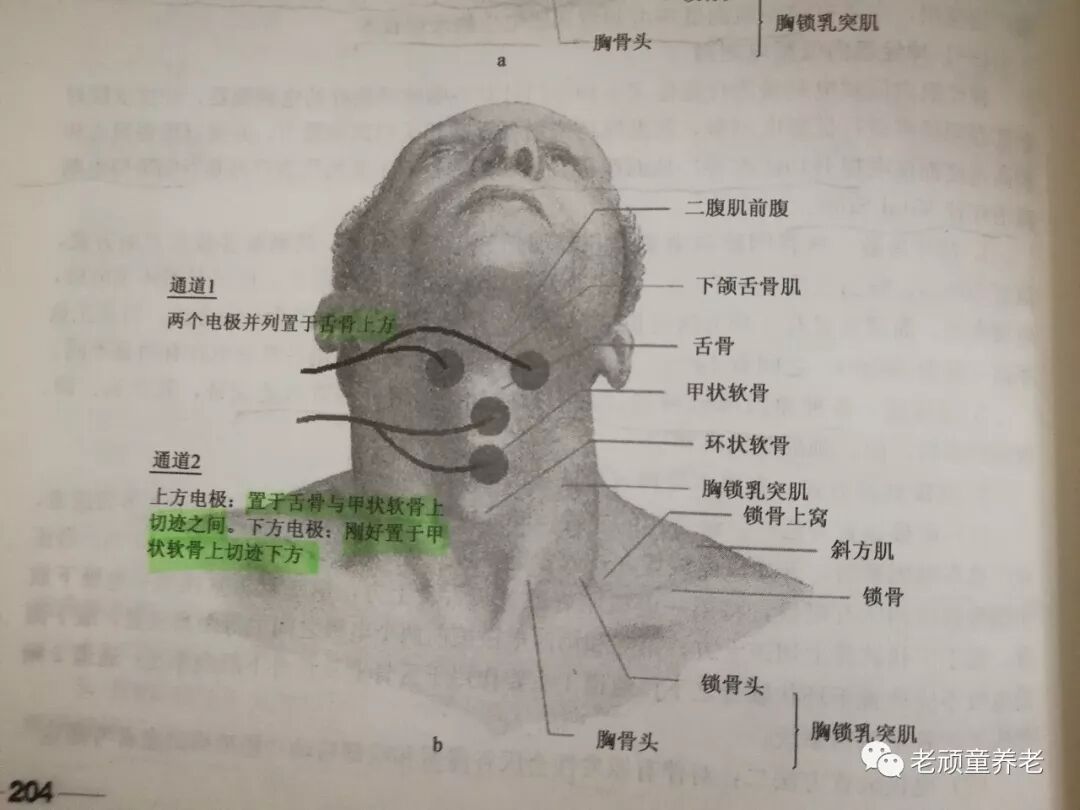 吞咽治疗仪怎么用吞咽障碍丨吞咽障碍电刺激治疗仪 Vital Stim 相关治疗细节_https://www.jmylbn.com_新闻资讯_第9张
