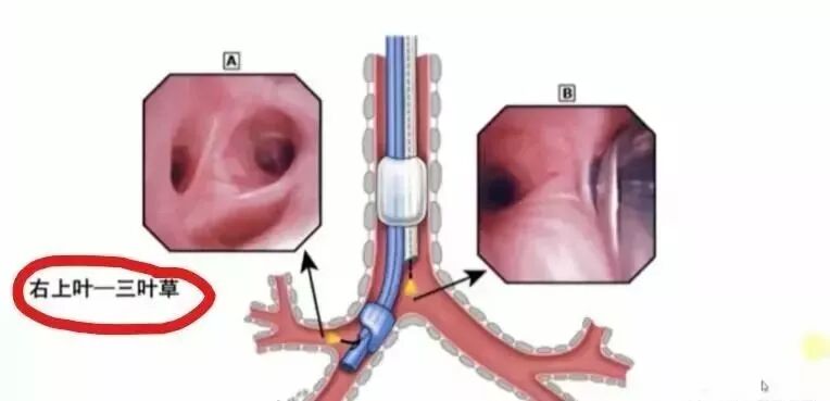 双腔气管插管怎么用科普｜一次性使用双腔支气管插管使用方法_https://www.jmylbn.com_新闻资讯_第2张