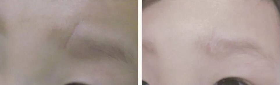 壳聚糖凝胶效果怎么样都在问的“擦伤／划伤／摔伤用什么不留疤”？答案来了_https://www.jmylbn.com_新闻资讯_第2张