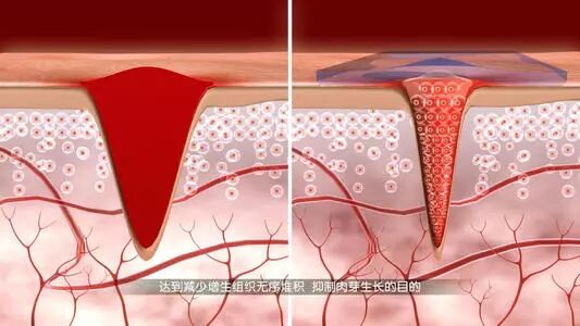 壳聚糖凝胶效果怎么样都在问的“擦伤／划伤／摔伤用什么不留疤”？答案来了_https://www.jmylbn.com_新闻资讯_第9张