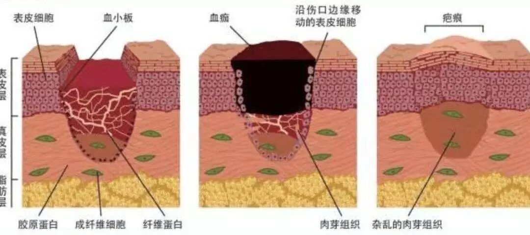 壳聚糖凝胶效果怎么样都在问的“擦伤／划伤／摔伤用什么不留疤”？答案来了_https://www.jmylbn.com_新闻资讯_第7张