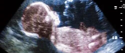 怀孕了到底要做几次超声？为什么第二次超声最重要？