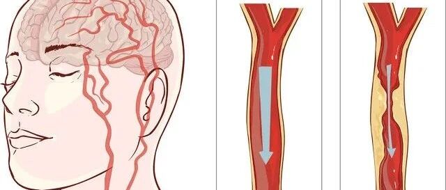 “世界卒中日”丨脑卒（cù ）中（zhòng），你该知道的远远不止是它的正确发音