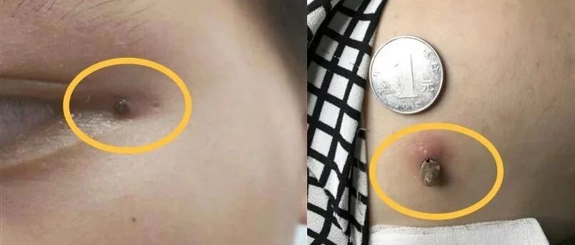 江苏已有37人感染这种病毒！夏季易发，可人传人！