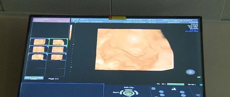 宝宝的第一张写真照——四维彩超