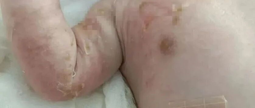 要命！台州妈妈喝姜汤，手一滑，滚烫姜汁泼在出生12天的宝宝身上…Ⅱ度烫伤！