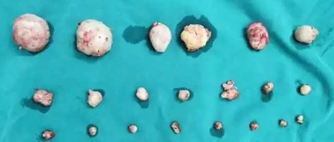 浙江丨女子的子宫被密密麻麻的肌瘤撑满！肌瘤大如拳头！她无比崩溃：我真没怀孕！