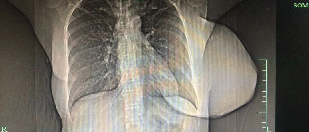 浙江丨阿姨托着“小山”大小的胸冲进医院大喊受不了！医生一看也慌了…