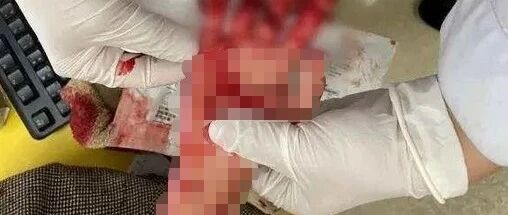 浙江丨恐怖！女娃趁着妈妈不注意，将手伸进正在工作的绞肉机里！瞬间血肉模糊！