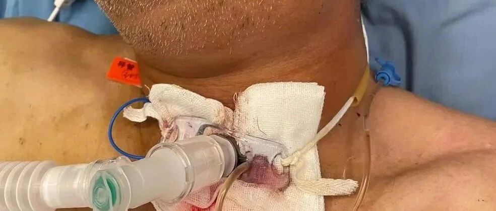 浙江丨男子牙痛，5天后脸肿到不能呼吸，差点被憋死！医生切开气管惊呆…