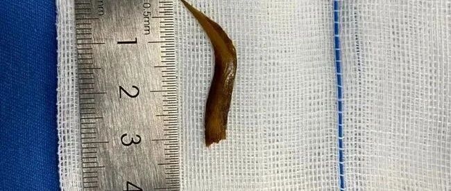 浙江丨老伯在厨房小便事后却毫无印象！医生又是开颅又是开腹！终于找到原因…