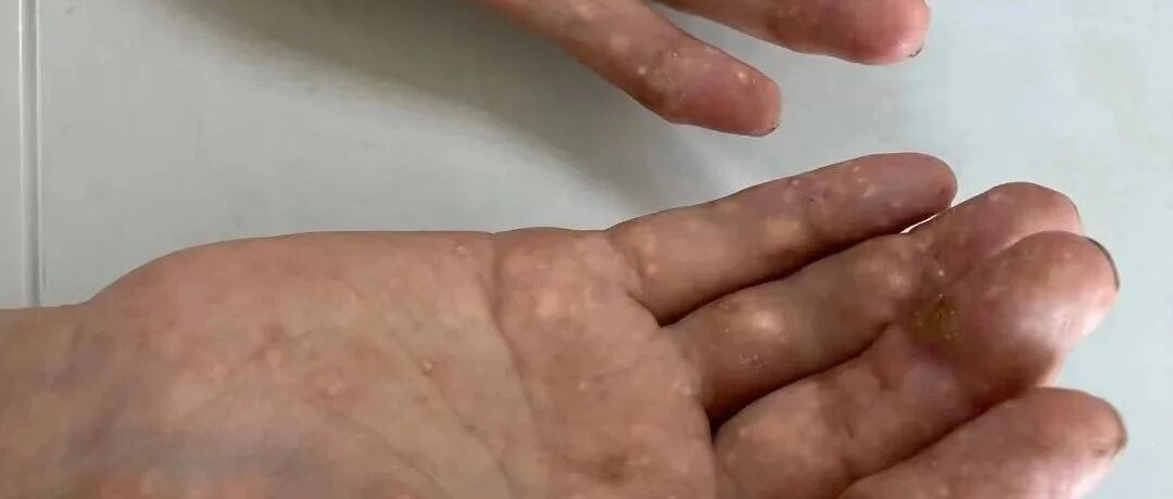 “盖被子，都痛到像被刀砍！”宁波大伯吃了3年网购的“神药”，吐血休克！差点…