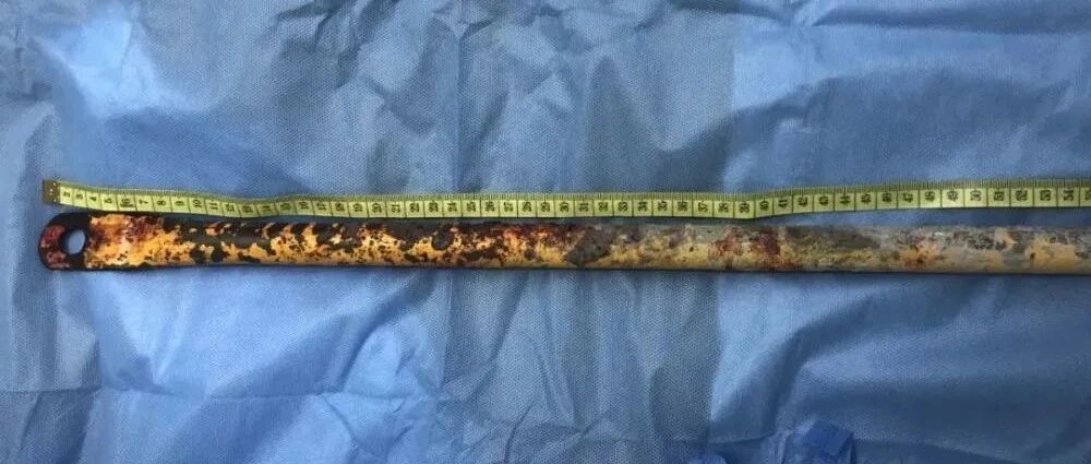 浙江丨好痛！！工人从2米高空坠落，钢管从他会阴部直直插入！