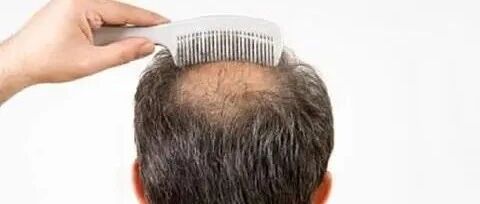 浙江丨老人秃顶，头顶被晒了几十年后，竟长出个流脓的疙瘩！医生惊了：这是肿瘤！