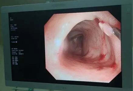 做试管遇见“子宫内膜息肉”，切还是不切？会影响成功率吗？