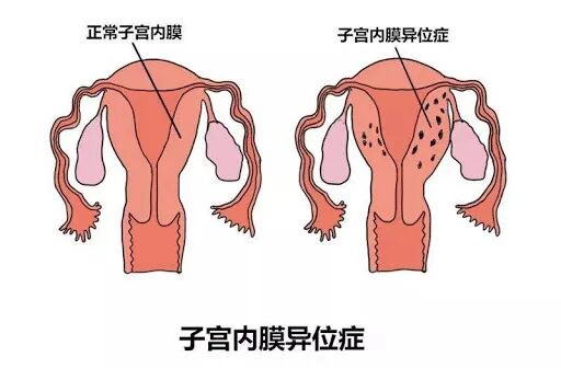 月经过多过少，也许是不孕的警告！