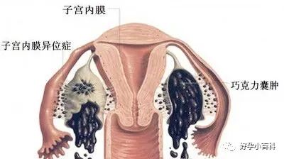 卵巢巧克力囊肿如何治疗？想怀孕怎么办？