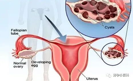 卵巢巧克力囊肿如何治疗？想怀孕怎么办？
