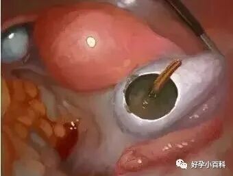 卵巢巧克力囊肿如何治疗？想怀孕怎么办？