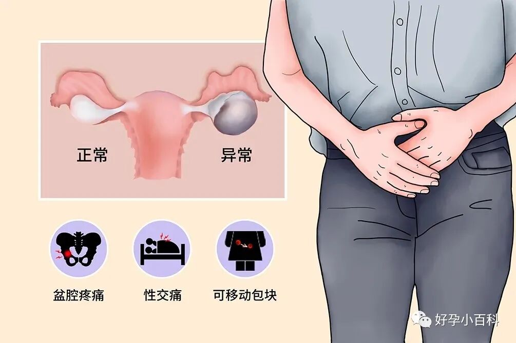 卵巢巧克力囊肿如何治疗？想怀孕怎么办？