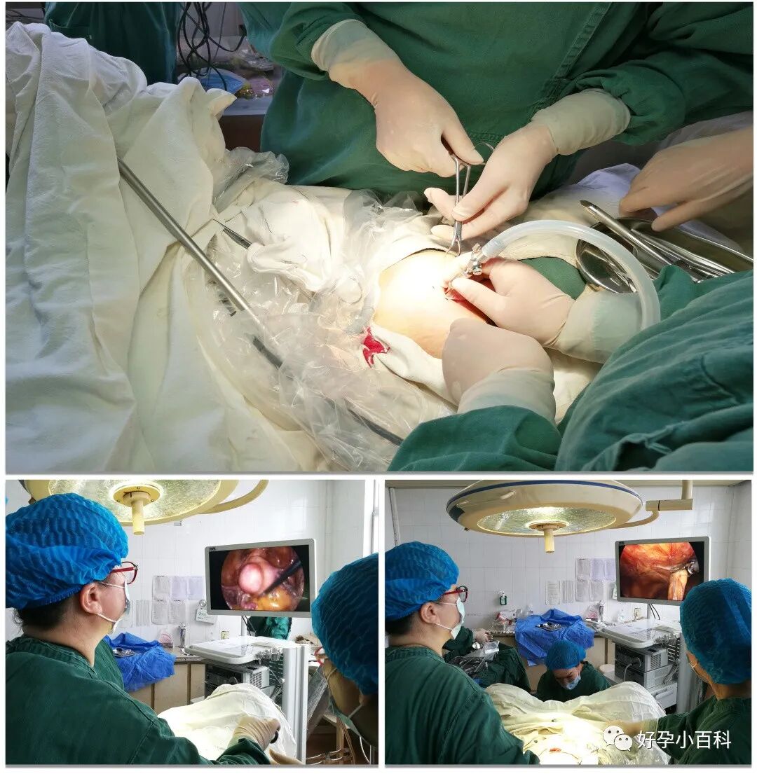 卵巢巧克力囊肿如何治疗？想怀孕怎么办？