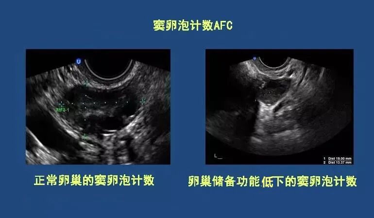 大项目检测卵巢储备功能，哪个更准确？"