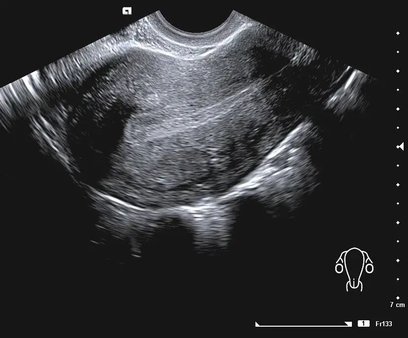 「试管知识篇」试管婴儿要成功，别让子宫内膜影响了成功率！