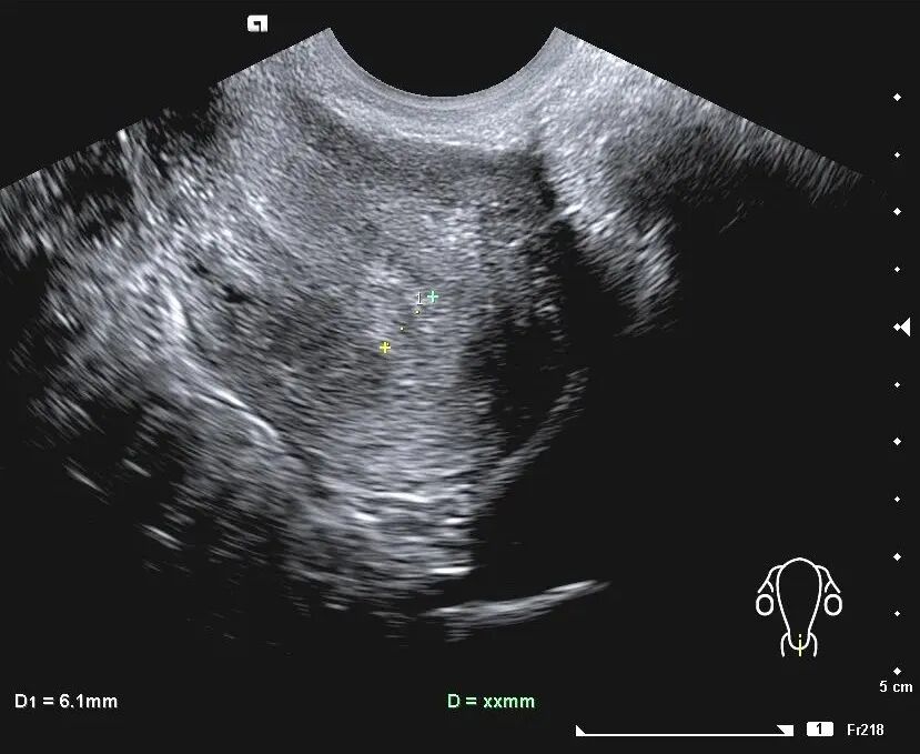 「试管知识篇」试管婴儿要成功，别让子宫内膜影响了成功率！