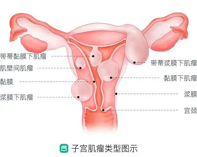 「试管知识篇」试管婴儿要成功，别让子宫内膜影响了成功率！