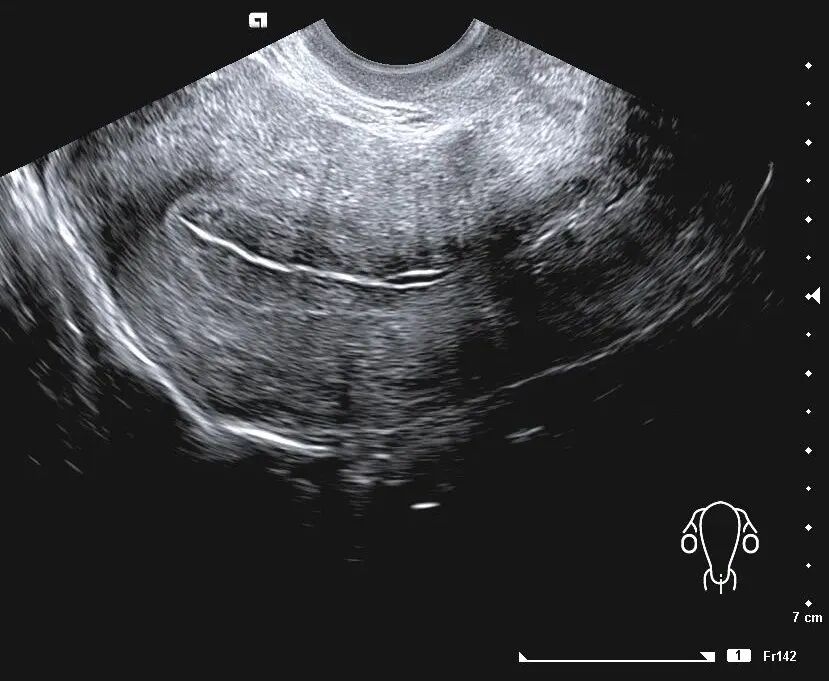 「试管知识篇」试管婴儿要成功，别让子宫内膜影响了成功率！