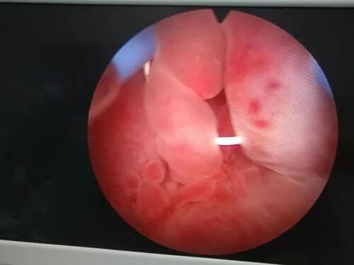 「试管知识篇」试管婴儿要成功，别让子宫内膜影响了成功率！