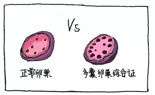 【备孕】一张图看懂多囊卵巢综合征PCOS