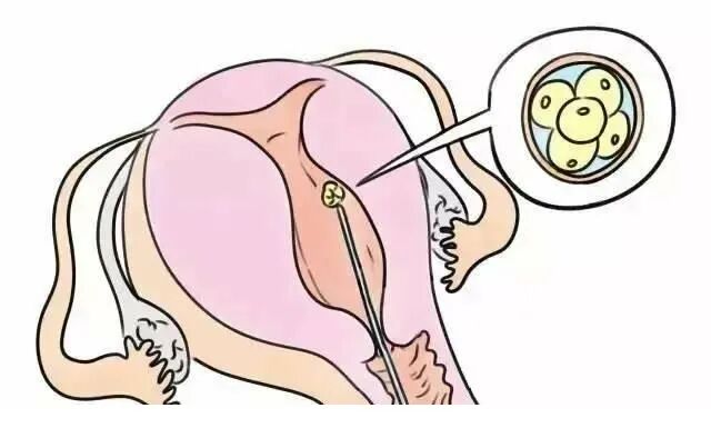 虎年助孕 | 试管饮食规划——胚胎移植篇！