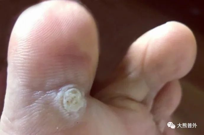 嵌在皮肤上的圆锥形角质增生硬结，顶端凸起，数目不定，一个或好几个。鸡眼的危害：肉钉子扎脚，让你行走在