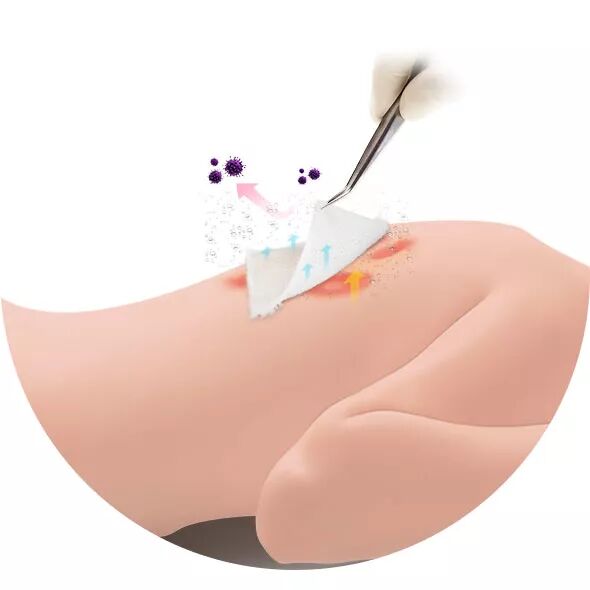 医用泡沫敷料怎么用常见的几种新型医用敷料_https://www.jmylbn.com_新闻资讯_第15张