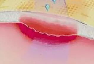 医用泡沫敷料怎么用常见的几种新型医用敷料_https://www.jmylbn.com_新闻资讯_第17张