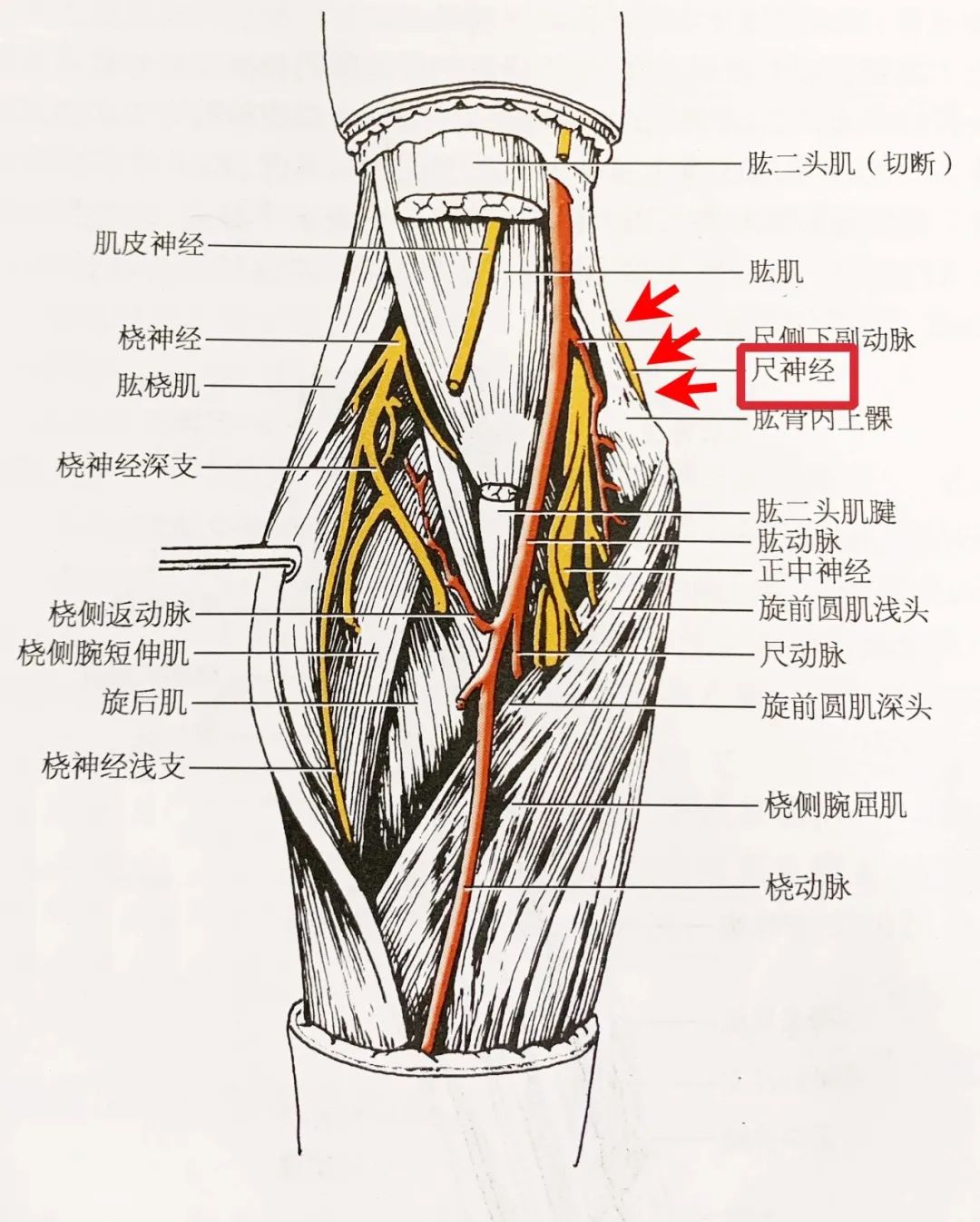红色箭头示尺神经在尺神经沟及前臂的解剖走形肘管综合征是指尺神