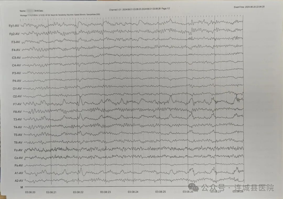 动态脑电图怎么看探索动态视频脑电图——洞察大脑的神秘电波_https://www.jmylbn.com_新闻资讯_第7张