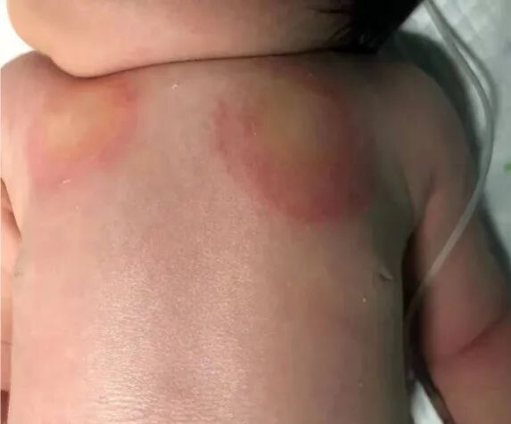 怎么撕敷料啊水胶体敷料的妙用，撕电极片时宝宝不再哭了！_https://www.jmylbn.com_新闻资讯_第5张