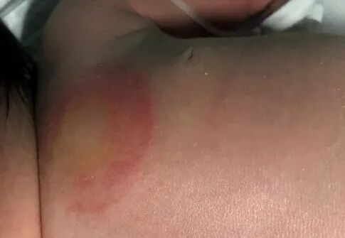 怎么撕敷料啊水胶体敷料的妙用，撕电极片时宝宝不再哭了！_https://www.jmylbn.com_新闻资讯_第3张