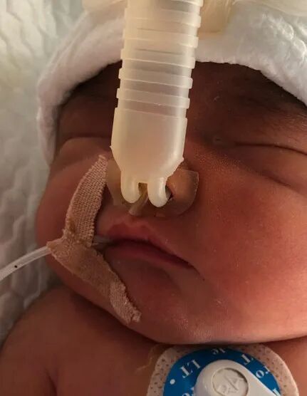 怎么撕敷料啊水胶体敷料的妙用，撕电极片时宝宝不再哭了！_https://www.jmylbn.com_新闻资讯_第8张