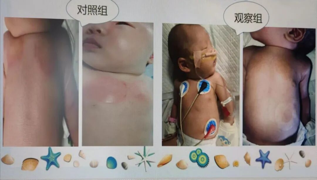 怎么撕敷料啊水胶体敷料的妙用，撕电极片时宝宝不再哭了！_https://www.jmylbn.com_新闻资讯_第10张