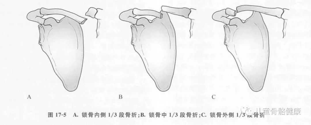 锁骨骨折的分型图片